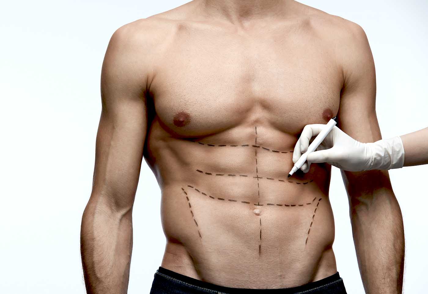 Abdominal Etching