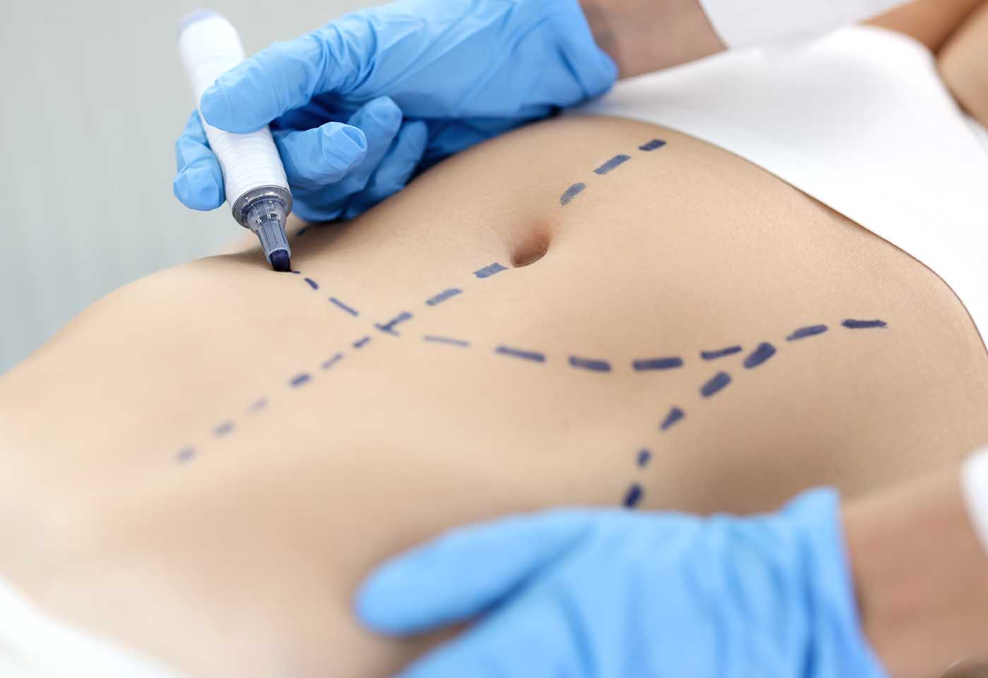 Paroi abdominale