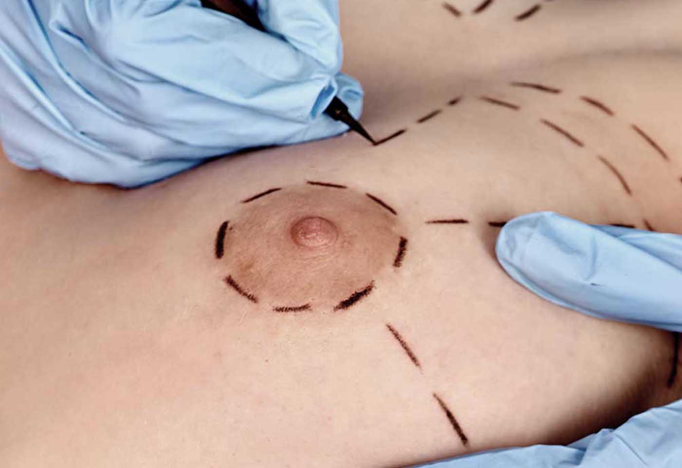 THORACOPLASTIE