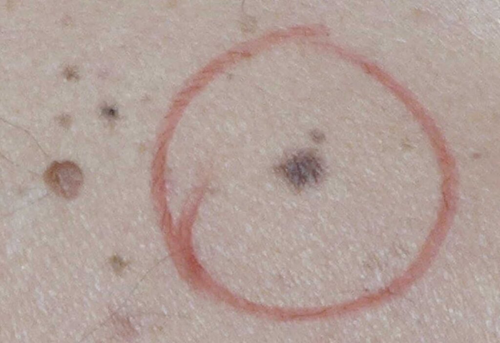 lesion cutnée