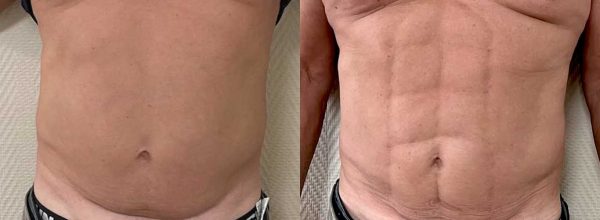 ABDOMINAL ETCHING DR COUSTAL 1
