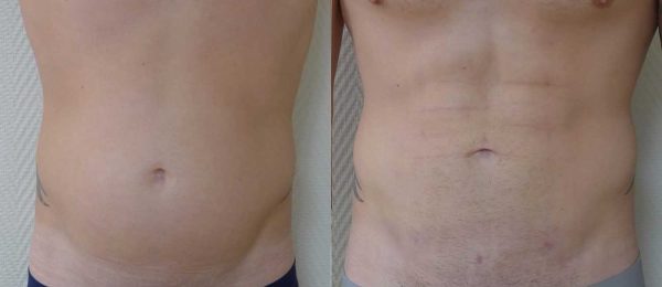 ABDOMINAL ETCHING DR COUSTAL 2
