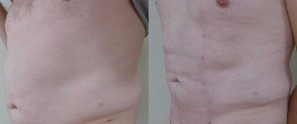 ABDOMINAL ETCHING DR COUSTAL 3