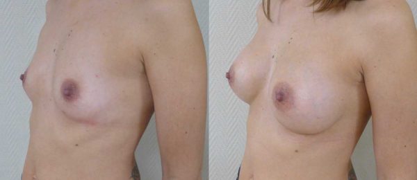 Augmentation mammaire implants 1