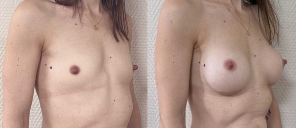 Augmentation mammaire implants 10