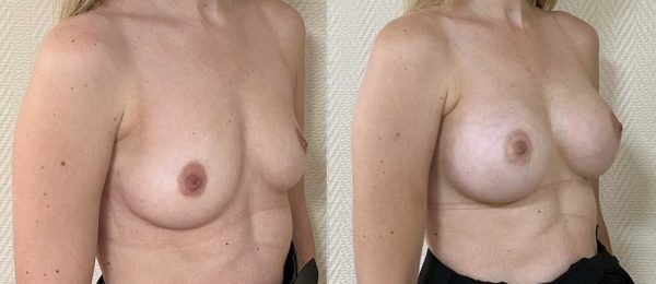 Augmentation mammaire implants 11