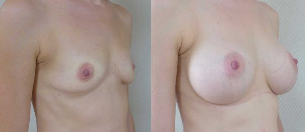 Augmentation mammaire implants 2