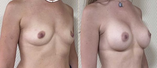 Augmentation mammaire implants 7