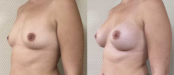 Augmentation mammaire implants 9
