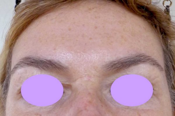 BOTOX 2