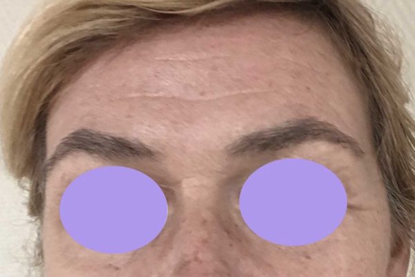 Botox 1