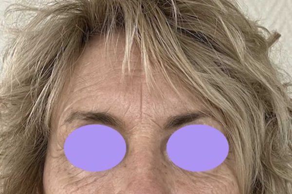 Botox 4