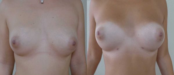 Lipomodelage des seins