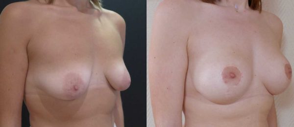 Ptose mammaire avec implant 1