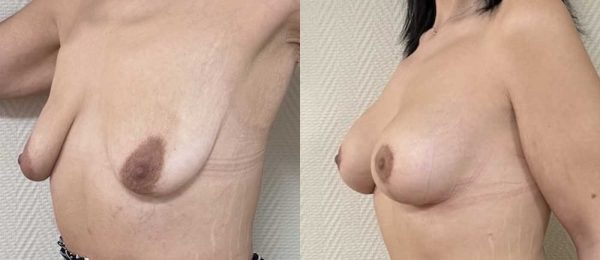 Ptose mammaire avec implant 3