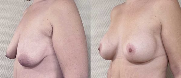 Ptose mammaire avec implant 4