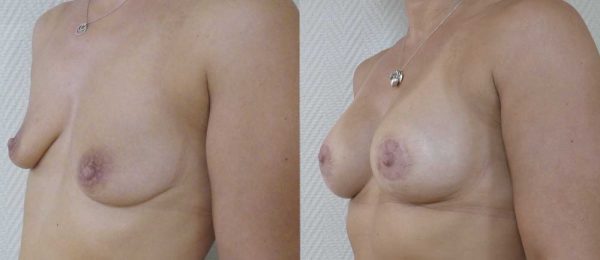 Ptose mammaire avec implant 5