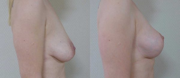 Ptose mammaire sans implant 1