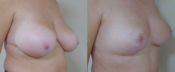 Ptose mammaire sans implant 3