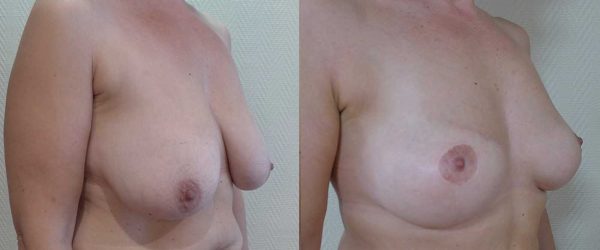 Ptose mammaire sans implant 4