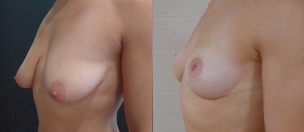 Ptose mammaire sans implant 5
