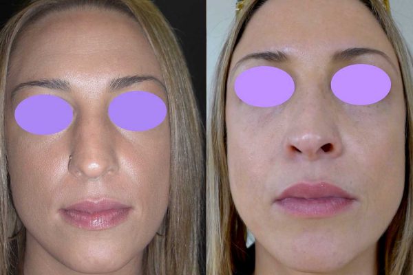 Rhinoplastie Dr Coustal 1