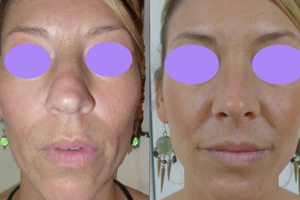 Rhinoplastie Dr Coustal 2