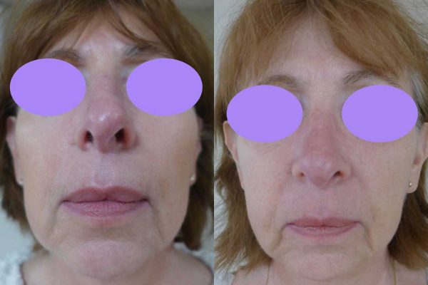 Rhinoplastie Dr Coustal 3