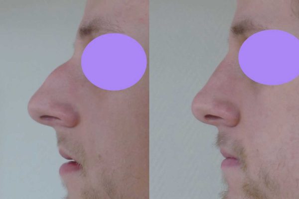 Rhinoplastie Dr Coustal 4