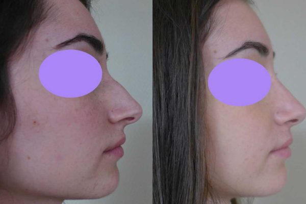 Rhinoplastie Dr Coustal 5