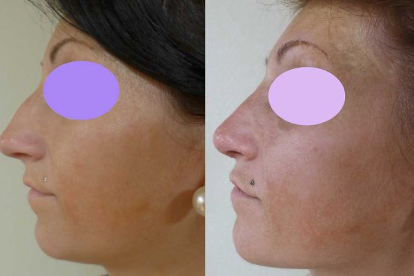 Rhinoplastie Dr Coustal 6