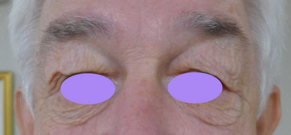 blépharoplastie dr coustal 1