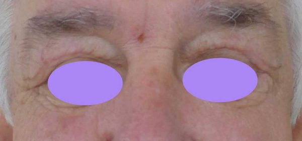 blépharoplastie dr coustal 2