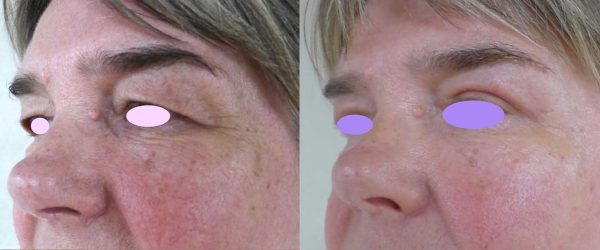 blépharoplastie dr coustal 3