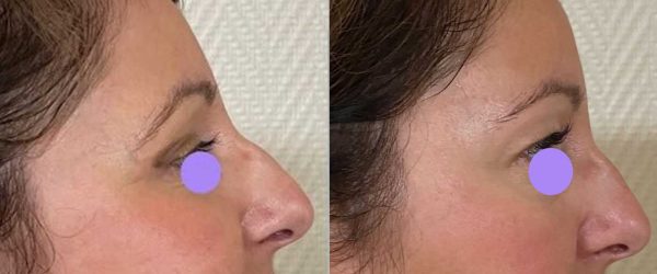 blépharoplastie dr coustal 4