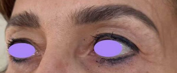 blépharoplastie dr coustal 5