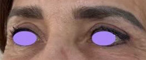blépharoplastie dr coustal 6
