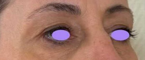 blépharoplastie dr coustal 7