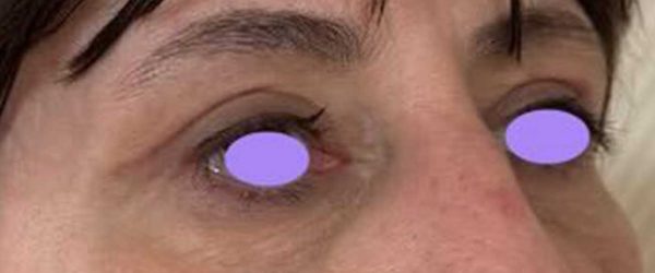 blépharoplastie dr coustal 8