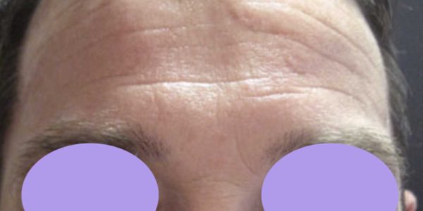 botox 3.1