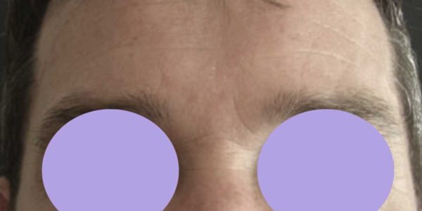 botox 3.2