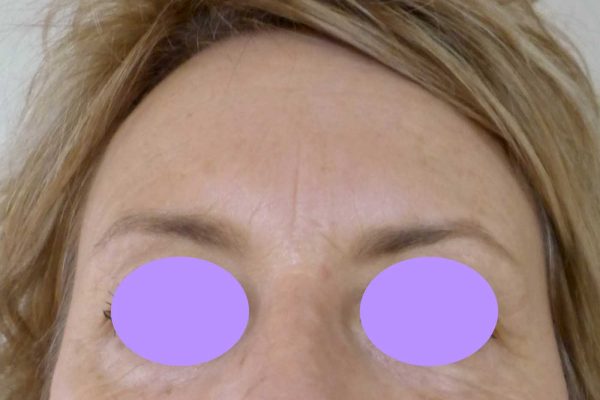 botox 5