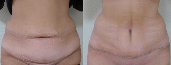 chirurgie paroi abdominale 1