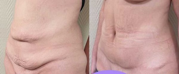 chirurgie paroi abdominale 10