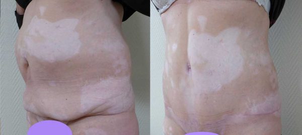 chirurgie paroi abdominale 2
