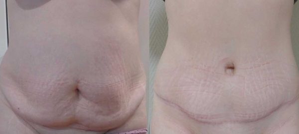 chirurgie paroi abdominale 3