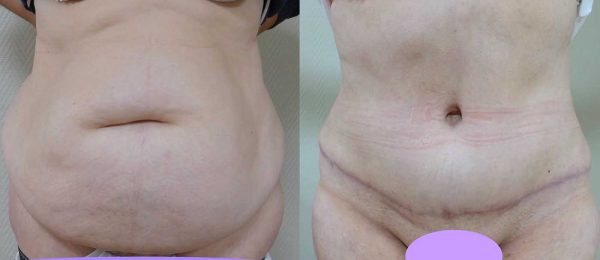 chirurgie paroi abdominale 4