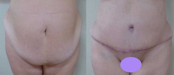 chirurgie paroi abdominale 5