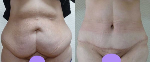 chirurgie paroi abdominale 6