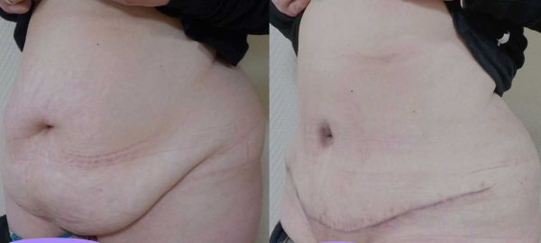 chirurgie paroi abdominale 7